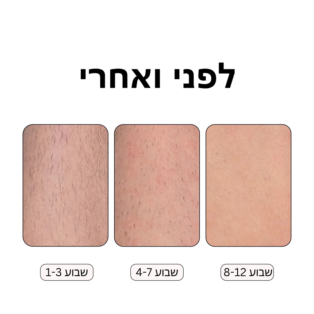 Rosebeam - מכשיר הסרת שיער ביתי