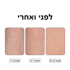 Rosebeam - מכשיר הסרת שיער ביתי